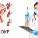 Penyebab Stroke, Dari Sumbatan Senyap sampai Pecah Pembuluh