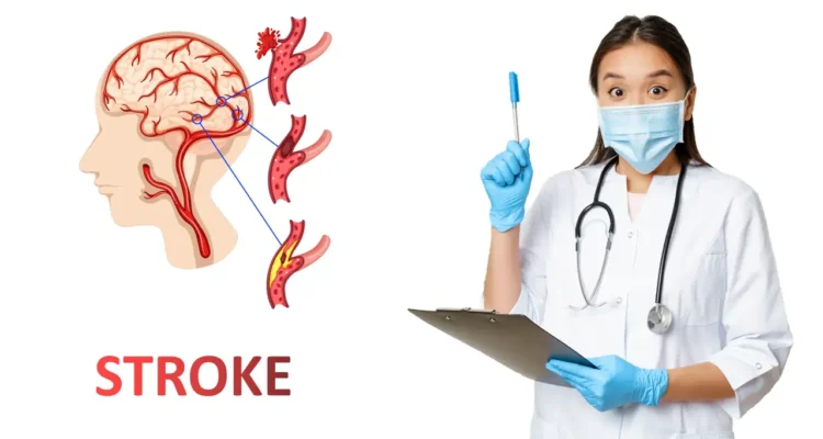 Penyebab Stroke, Dari Sumbatan Senyap sampai Pecah Pembuluh
