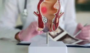 Penyebab Ambeien yang Sering Terjadi, dari Sembelit hingga Duduk Terlalu Lama